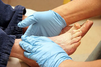 Diabetic foot treatment in the Manatee County, FL: Bradenton (University Park, Bayshore Gardens, Palmetto, Foxleigh, Lakewood Ranch, Ellenton, Parrish) and Sarasota County, FL: Sarasota (South Gate Ridge, Sarasota Springs, Venice, Laurel, Osprey, Fruitville, South Sarasota, North Sarasota, Southgate, Bee Ridge) areas