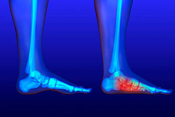 Flat feet and Fallen Arches treatment in in the Manatee County, FL: Bradenton (University Park, Bayshore Gardens, Palmetto, Foxleigh, Lakewood Ranch, Ellenton, Parrish) and Sarasota County, FL: Sarasota (South Gate Ridge, Sarasota Springs, Venice, Laurel, Osprey, Fruitville, South Sarasota, North Sarasota, Southgate, Bee Ridge) areas