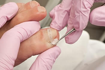 Ingrown toenails treatment in the Manatee County, FL: Bradenton (University Park, Bayshore Gardens, Palmetto, Foxleigh, Lakewood Ranch, Ellenton, Parrish) and Sarasota County, FL: Sarasota (South Gate Ridge, Sarasota Springs, Venice, Laurel, Osprey, Fruitville, South Sarasota, North Sarasota, Southgate, Bee Ridge) areas