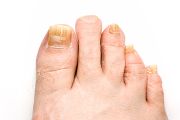 Fungus toenails treatment in in the Manatee County, FL: Bradenton (University Park, Bayshore Gardens, Palmetto, Foxleigh, Lakewood Ranch, Ellenton, Parrish) and Sarasota County, FL: Sarasota (South Gate Ridge, Sarasota Springs, Venice, Laurel, Osprey, Fruitville, South Sarasota, North Sarasota, Southgate, Bee Ridge) areas